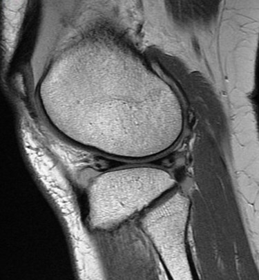 Figure 3 for case Meniscus tears ( RID2762 )